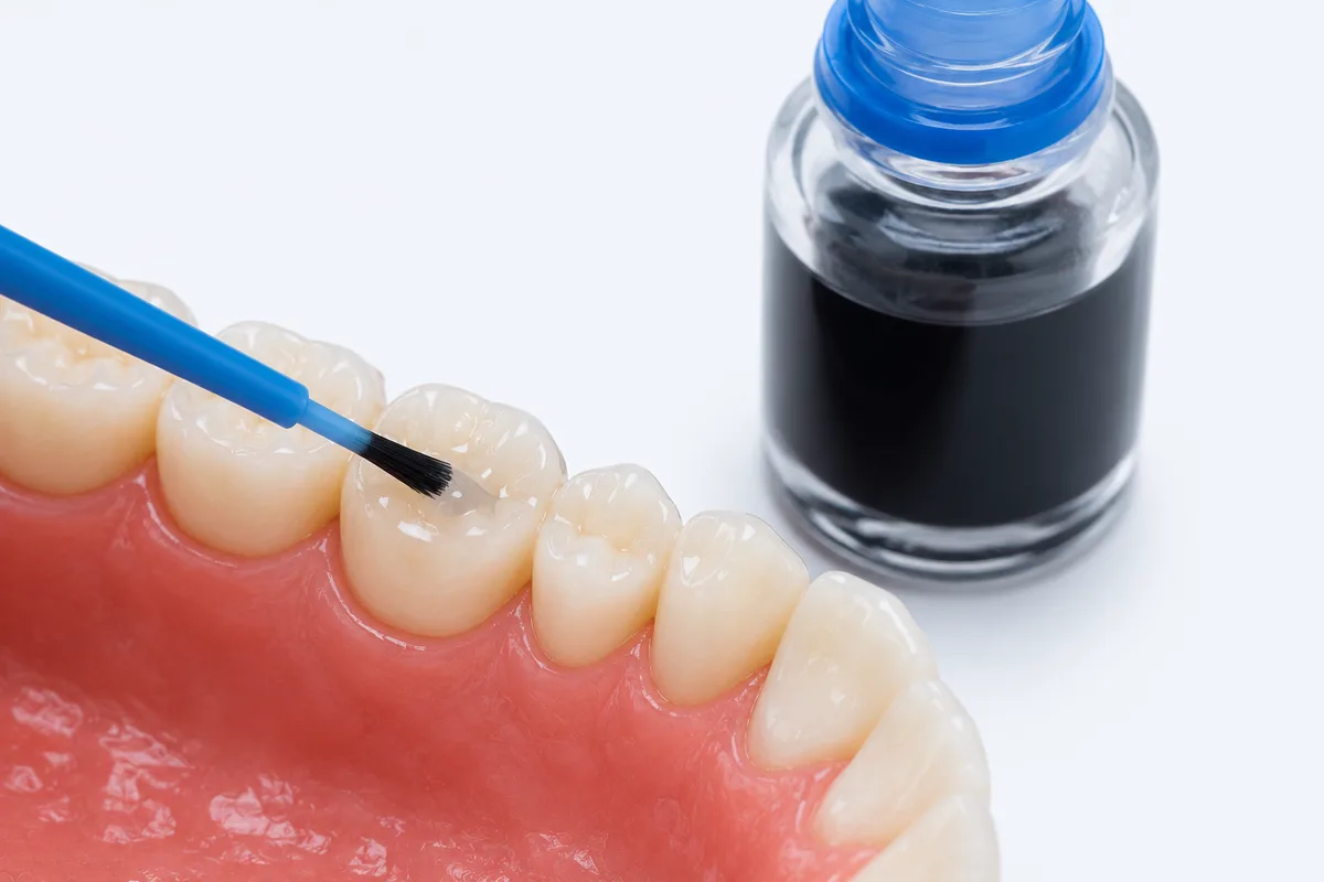 Silver diamine fluoride cavity treatment