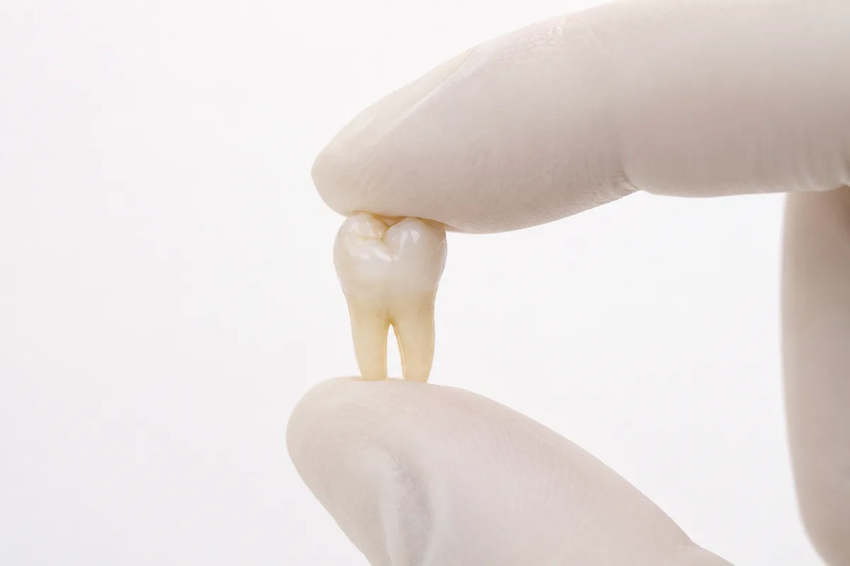 Extracted tooth held in gloved fingers