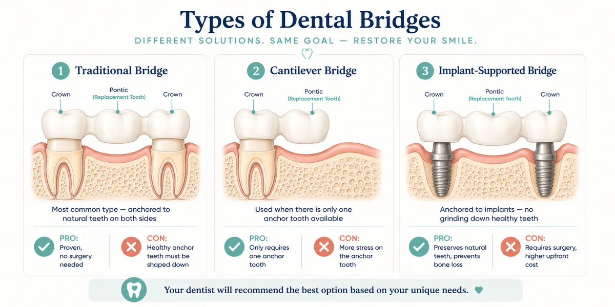 Types of dental bridges comparison infographic